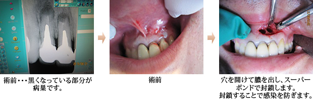 歯根端切除術1