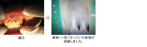 歯根端切除術2