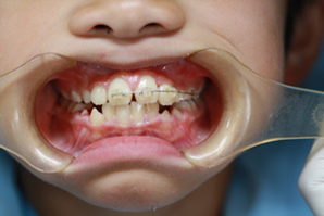 前歯部の歯列不全のため矯正1