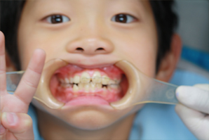 前歯部の歯列不全のため矯正2