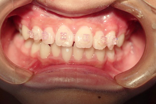 前歯部の歯列不全のため矯正3