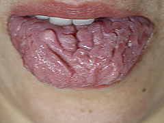溝状舌